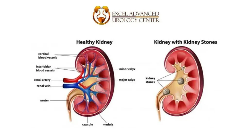 Retrograde Intrarenal Surgery