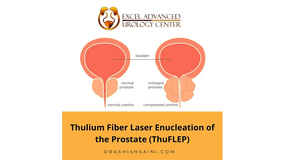 What is ThuFLEP/HoLEP?