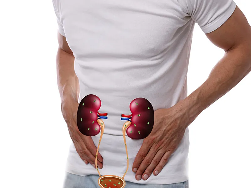 Urinary Bladder Stones Test & Diagnosis