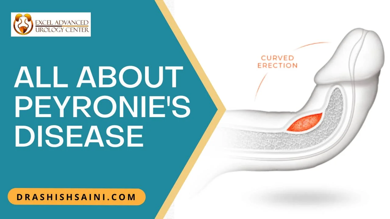 All about Peyronie Disease by Dr Ashish Saini